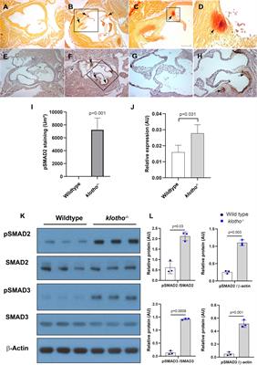 Increased TGFβ1 and SMAD3 Contribute to Age-Related Aortic Valve Calcification
